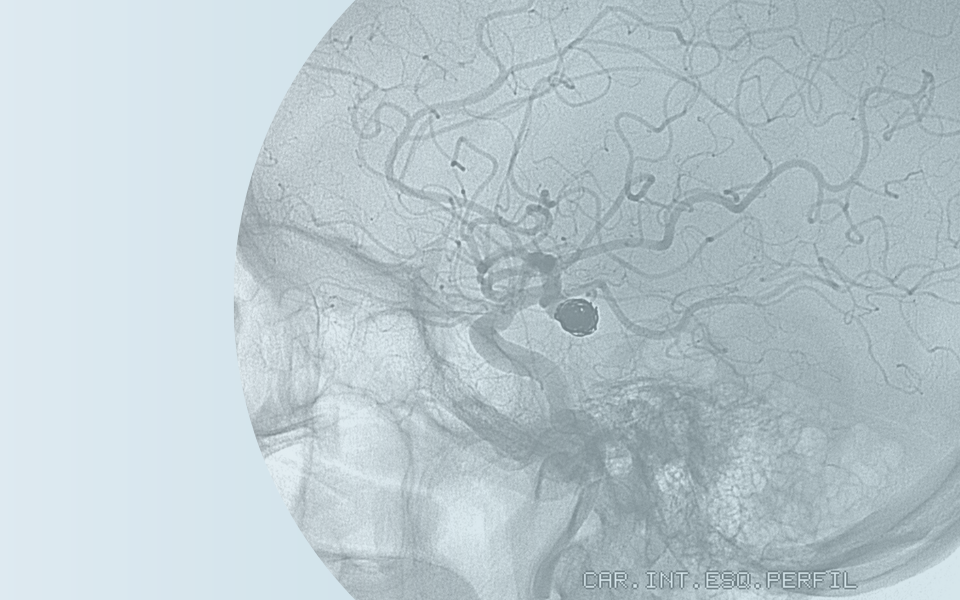 Microcatheter Configuration